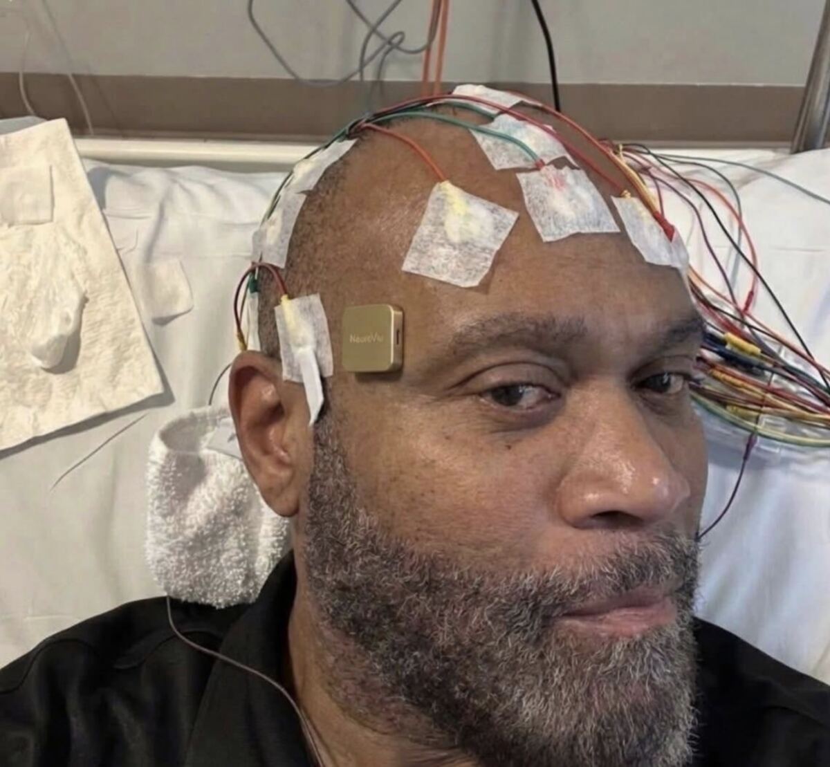 A person wearing scalp EEG electrodes with leads bundled to a recording system.